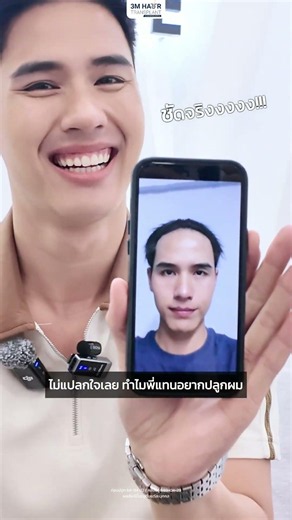 @_tan.trw has reached 1 year since his hair transplant. Today, he’s revealing the secret behind w...