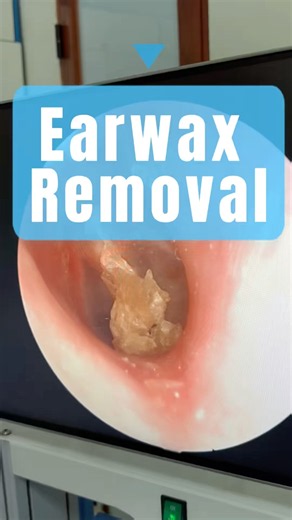 Holding Breath for This Eardrum Clean!| Dr Tuan ENT #asmr