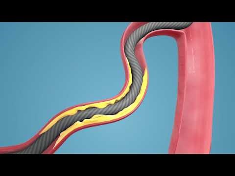 Turnpike® Catheters, Why Torque Matters