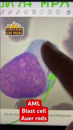 🔬 How to Identify Acute Leukemia on a Blood Smear | Pathology Explained