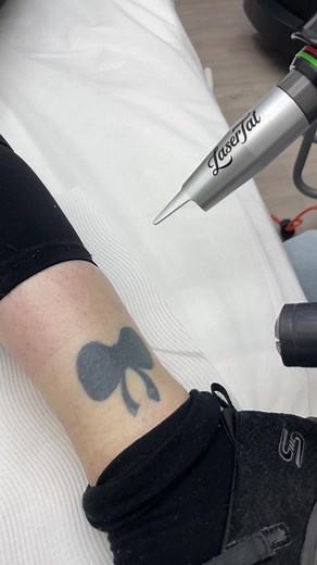 Laser Tattoo Removal Sound Effects Compilation