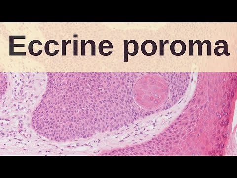 Eccrine Poroma - Pathology mini tutorial