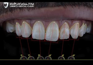 3.1K views · 151 reactions | A case where the inclination of the teeth was fixed and the missing lateral was camouflaged by reshaping the canine in its position حالة تم تجميلها بتعديل ميلان الاسنان و التعويض عن القاطع المفقود بتغير شكل الناب | Dr. Mohammed Naji | Facebook