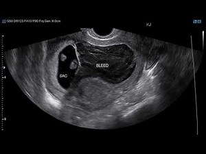 What Is Subchorionic Hematoma- Causes Of Subchorionic Hematoma