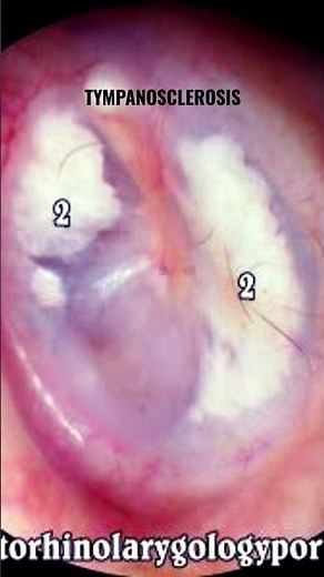 tympanosclerosis