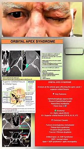 Orbital Apex Syndrome: When Vision & Eye Movement Fail A quick review of Orbital Apex Syndrome — where a lesion at the back of the orbit affects multiple cranial nerves and the optic nerve. Causes include tumors, infections, trauma, and inflammatory conditions like Tolosa-Hunt. ORBITAL APEX SYNDROME A lesion at the orbital apex affecting the optic canal superior orbital fissure. 🔍 Key Features: · Ophthalmoplegia (spares SO) · Ptosis & fixed/dilated pupil · Nasociliary numbness · Vision loss 👁️