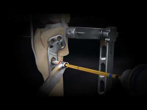 Understanding TPLO Surgery: A Step-by-Step Guide