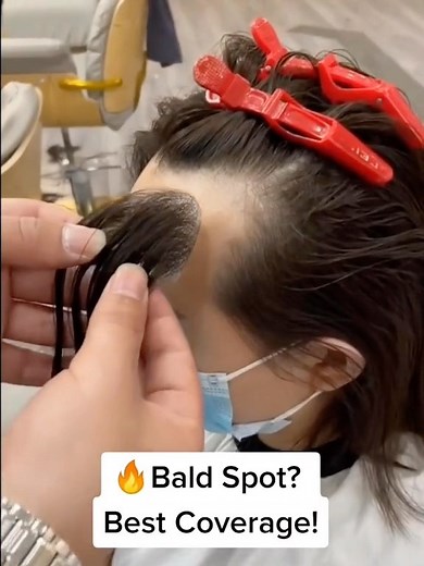 UniWigs ® on Instagram: "Female pattern baldness is the most common type of hair loss in women. It is usually permanent and may affect self-esteem and cause anxiety. . UniWigs hair patches are one of the options. Link in the bio. Click “Shop Hair Patches”. Don’t forget to order the tape/adhesive. . #uniwigstopper #uniwigshelperhair #femalepatternbaldness"