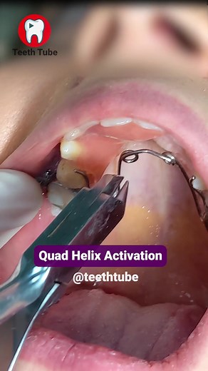 Quad Helix Activation #quadhelix #dentist #dentalwork #teethtube