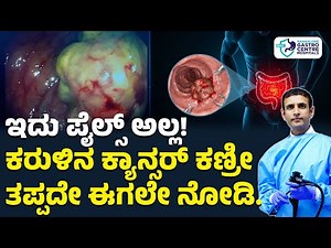 Colon Cancer | Colonoscopy Footage Showing How Colon Cancer Looks Inside | Symptoms & Treatment