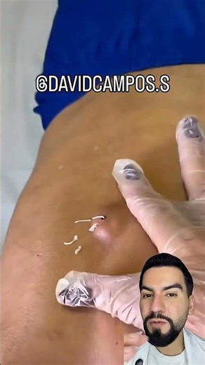 Sebaceous Cyst Explained