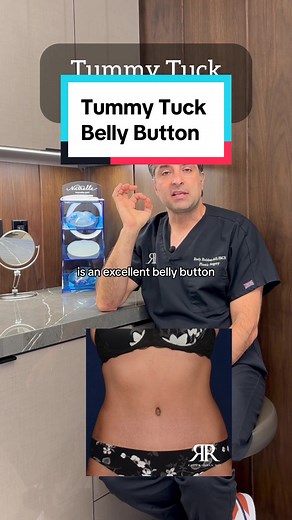 One of the most important elements of a well done tummy tuck is an excellent belly button. This is because while you can hide other elements, such as the scar, you can’t hide your belly button. Often times I see individuals with belly buttons that are too large, have visible stitches, or look like a thin slit. A belly button after a tummy tuck should be visually and aesthetically pleasing, not a dead giveaway that they’ve had a surgery. Have any questions about belly buttons after a tummy tuck? 