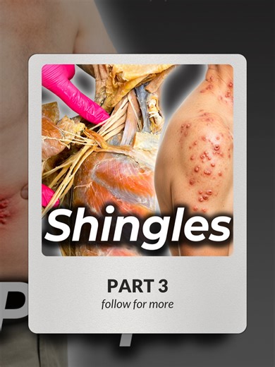 Understanding Shingles: Pain and Treatment Explained