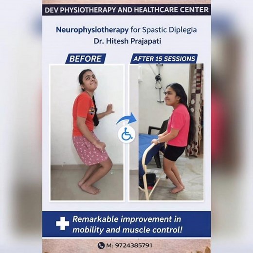 Physiotherapy for Spastic Diplegia Case | Before & After 15 Sessions of Neurophysiotherapy