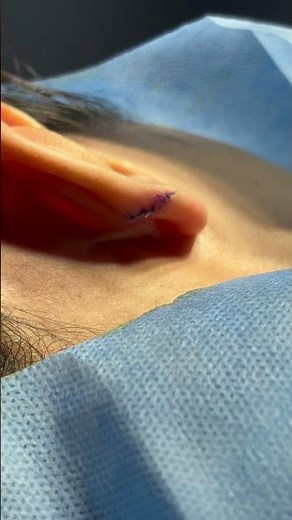 Ear Keloid Removal Surgery | Dr. Rajesh Vasu | Best plastic surgeon in Hyderabad