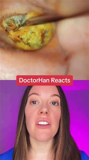 Massive Ear Wax Impaction