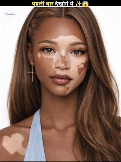 What is vitiligo? 🤯