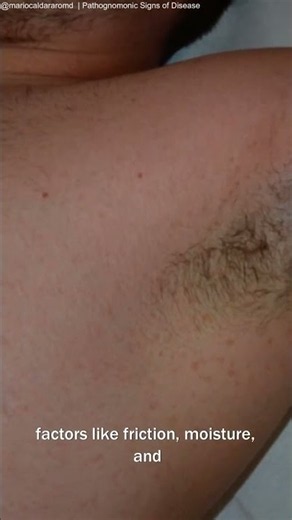 MECHANISM MINUTE: What explains Crowe's sign in neurofibromatosis type I?