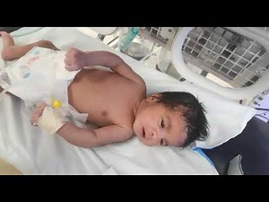 Tonic (muscle stiffness) neonatal seizure, acute bilirubin encephalopathy,BIND, dr Ahmed