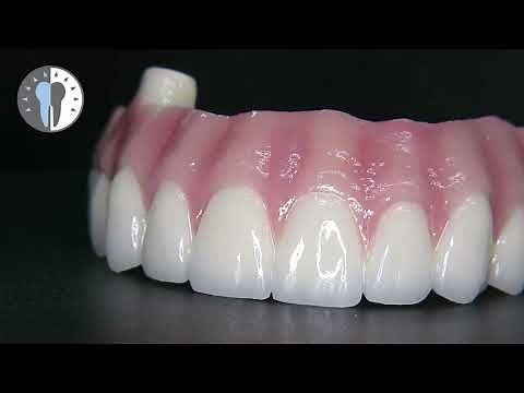 Zahnersatz für All on 4® Implantate im Oberkiefer aus der Zahnarztpraxis Dr. med. dent. Mustafa Ayna
