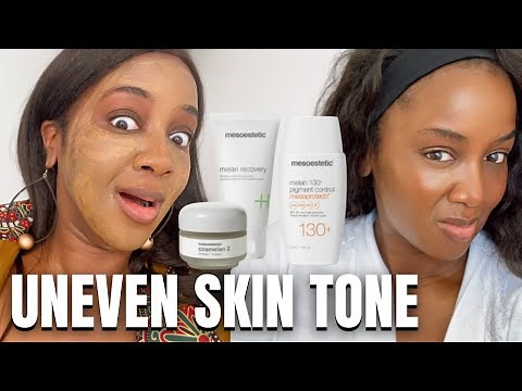 COSMELAN Chemical Peel for Hyperpigmentation (Black Skin) Diary Pt 1