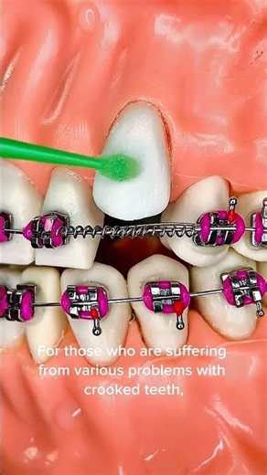 How Teeth Are Straightened | Braces Treatment Step by Step | Education Films