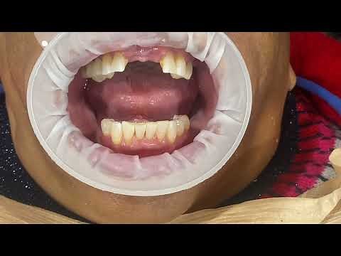 Wash Impression Technique for Removable Partial Denture
