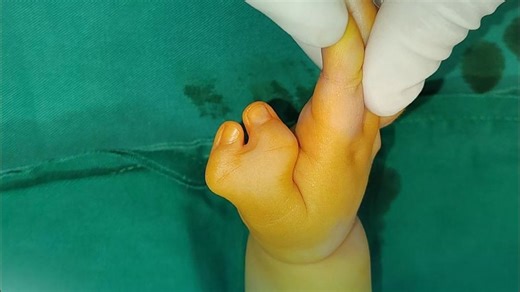 从“蟹钳手”到正常手，多指宝宝手术真实记录