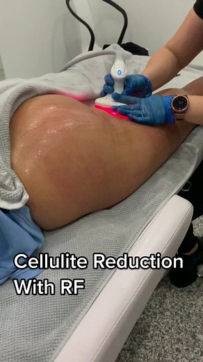 👋🏻 Bye Bye Cellulite! Advanced RF (Radio Frequency) works to melt away stubborn fat plus tighten skin. #cellulite #body #bodycontouring #sydney #explore