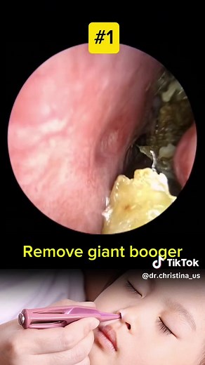 Effective Ways to Clear a Stuffy Nose and Remove Boogers