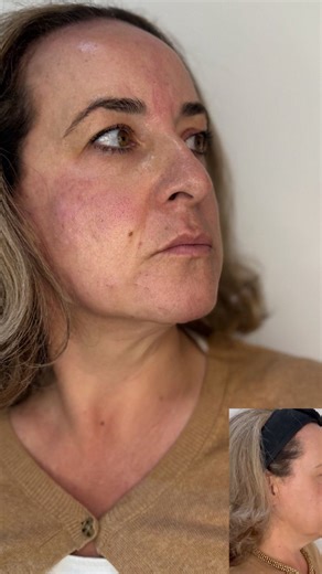 MODELS WANTED!!!! Do you want to turn back time? 🕰️ Face threads are one of the most powerful treatments to rewind the clock—naturally. As we age, our skin loses collagen and elasticity, causing sagging, jowls and deeper lines. FaceTime threads (also known as PDO or COG threads) gently lift the skin while stimulating your body to produce new collagen. This collagen acts like your skin’s own scaffolding—tightening, firming and rejuvenating over the next few weeks. ✨ Why clients love them: • Inst