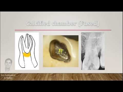 How to manage calcified chamber and canals during RCT??