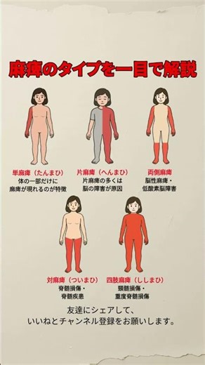 麻痺のタイプを一目で解説｜部位で変わる呼び方 #麻痺#麻痺の種類#単麻痺#片麻痺#両側麻痺#対麻痺#四肢麻痺#神経障害#脊髄損傷#脳障害#医療知識#健康情報
