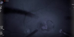 Intraoperative Fluorescein Angioscopy to Diagnose Broken Retinal Aneurysm - Eyetube