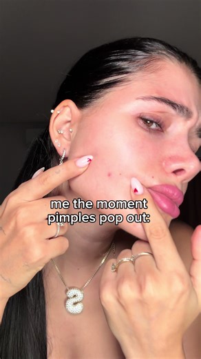 bye pimples hack 👋🏻✨ #antiacne #zinc #skincare | zinc for acne