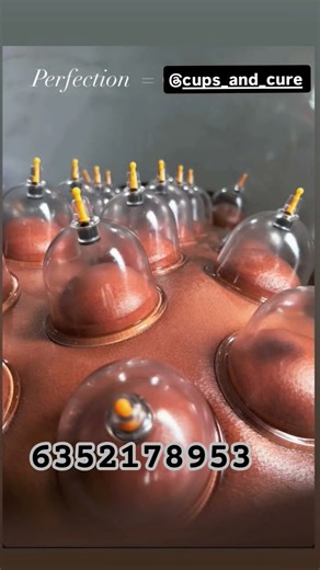 Smooth & Precise Cupping Therapy | Real Results You Can Feel! VADODARA. #hijama