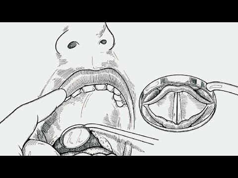 IDL in 60 Seconds. Master Indirect Laryngoscopy: Step-by-Step Exam Guide