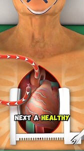 543K views · 7.7K reactions | Open Heart Bypass Surgery (3D Animation) #openheartsurgery #openheart #heart #hearthealth #heartdisease #heartbeat #heartbypasssurgery #surgery #surgeon #doctor #anesthesia #arms #blockage #bloodveins #vessels #veins #health #healthyheart #medical3danimation #3dmedicalanimation | Medcare777 | Facebook