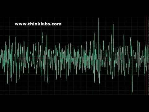 Aneurysm of Sinus of Valsalva