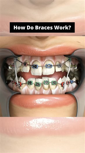 How Do Braces Work to Straighten Your Teeth? | Dental Daily