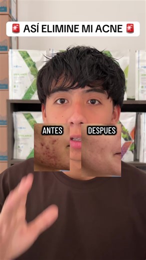 Si tienes acné, espinillas y la piel grasa aquí te comparto esta solución 😊✅ #acne #alphabalance #desintoxicacion