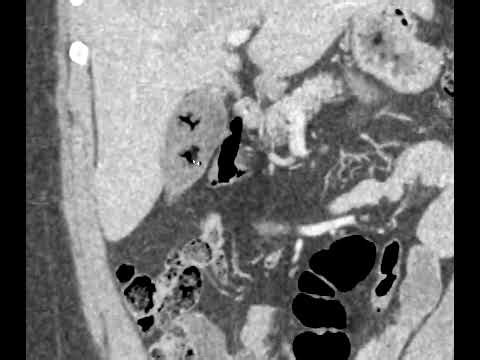 Mercedes Benz sign of gallstones on CT