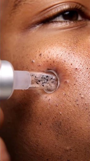 Blackhead Gunk Removal — Smooth Finish