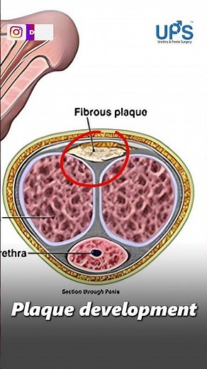 Painful Erection & Curved Penis?