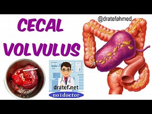 Cecal Volvulus / Causes / Pathology / Symptoms / Diagnosis / ...