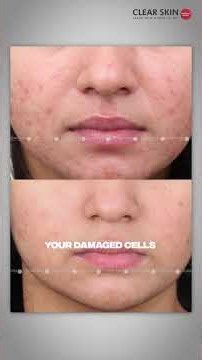 CO2 Laser Acne Scar Treatment: Transform Your Skin in Just One Session! | Clear Skin Clinic