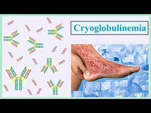 cryoglobulinemia
