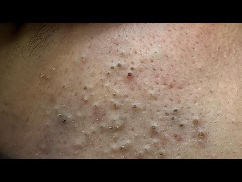 Sebum Control & Blackhead Removal | Korean Skincare Routine