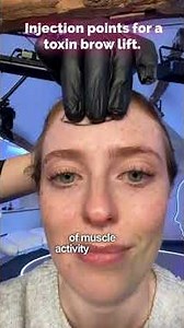 Injection points for a Botox brow lift