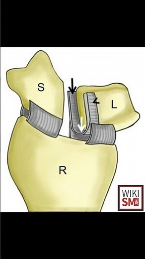 Scapholunate Joint Explained! 🦴 #meded #anatomy #physiotherapy #atc #orthopedic